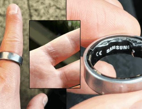 Samsung Galaxy Ring ရဲ့ ဘက်ထရီဖောင်းကားလာတဲ့အတွက် ဆေးရုံသွားလိုက်ရတဲ့ အမျိုးသား