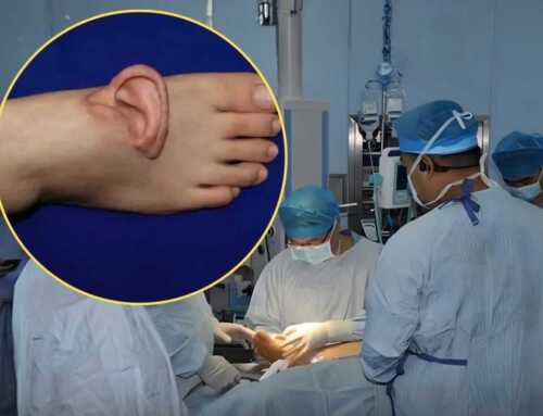 ပြတ်သွားတဲ့ နားရွက်ကို ခြေထောက်မှာ ခေတ္တဆက်ထားပြီးမှ ပြန်တပ်ပေးတဲ့ ကမ္ဘာ့ပထမဆုံး ခွဲစိတ်ကုသမှု